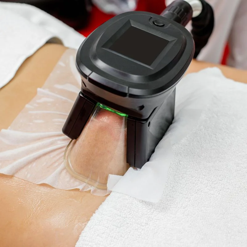 Fat Freezing treatment Ashby-de-la-Zouch